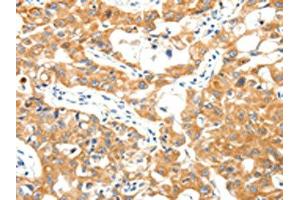 The image on the left is immunohistochemistry of paraffin-embedded Human lung cancer tissue using ABIN7192878(TRAF3 Antibody) at dilution 1/40, on the right is treated with synthetic peptide. (TRAF3 抗体)