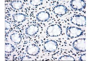 Immunohistochemical staining of paraffin-embedded Adenocarcinoma of ovary tissue using anti-CHEK2mouse monoclonal antibody. (CHEK2 抗体)