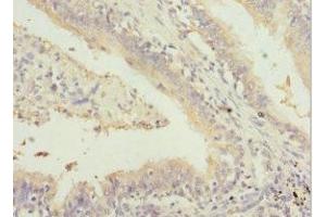Immunohistochemistry of paraffin-embedded human lung cancer using ABIN7153505 at dilution of 1:100 (GABRR1 抗体  (AA 365-465))