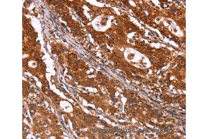 Immunohistochemistry of Human gastric cancer using ABI1 Polyclonal Antibody at dilution of 1:40 (ABI1 抗体)