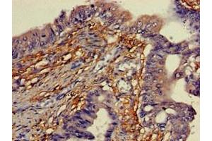 Immunohistochemistry of paraffin-embedded human colon cancer using ABIN7166338 at dilution of 1:100 (YIPF3 抗体  (AA 2-148))