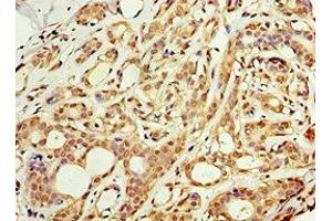 Immunohistochemistry of paraffin-embedded human breast cancer using ABIN7143228 at dilution of 1:100 (ACSM3 抗体  (AA 387-586))