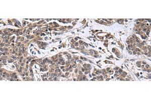 Immunohistochemistry of paraffin-embedded Human colorectal cancer tissue using MBL2 Polyclonal Antibody at dilution of 1:25(x200) (MBL2 抗体)