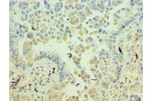 Immunohistochemistry of paraffin-embedded human lung cancer using ABIN7156537 at dilution of 1:100 (ICAM2 抗体  (AA 25-223))