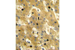 Formalin-fixed and paraffin-embedded human hepatocarcinoma reacted with SCP2 Antibody , which was peroxidase-conjugated to the secondary antibody, followed by DAB staining. (SCP2 抗体  (AA 358-385))