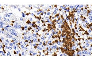 Detection of CASP1 in Human Liver cancer Tissue using Polyclonal Antibody to Caspase 1 (CASP1) (Caspase 1 抗体  (AA 120-297))