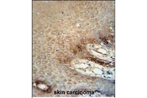 ITA6 Monoclonal Antibody (ABIN658988 and ABIN2838034) immunohistochemistry analysis in formalin fixed and paraffin embedded human skin carcinoma followed by peroxidase conjμgation of the secondary antibody and DAB staining. (ITGA6 抗体)