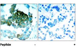 Immunohistochemical analysis of paraffin-embedded human lung carcinoma tissue using PRKCQ polyclonal antibody . (PKC theta 抗体)