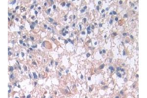 Detection of IL33 in Human Glioma Tissue using Monoclonal Antibody to Interleukin 33 (IL33) (IL-33 抗体  (AA 112-270))