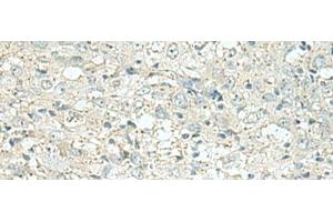 Immunohistochemistry of paraffin-embedded Human esophagus cancer tissue using DENND6A Polyclonal Antibody at dilution of 1:120(x200) (FAM116A 抗体)