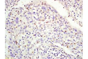 Formalin-fixed and paraffin embedded human larngeal cancer labeled with Rabbit Anti-RFC1 Polyclonal Antibody, Unconjugated (ABIN1387575) at 1:200 followed by conjugation to the secondary antibody and DAB staining