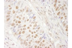 Immunohistochemistry (IHC) image for anti-SWI/SNF Related, Matrix Associated, Actin Dependent Regulator of Chromatin, Subfamily A, Member 4 (SMARCA4) (AA 75-125) antibody (ABIN7448446)