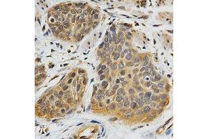 Immunohistochemistry of paraffin-embedded human esophageal cancer using ABO antibody at dilution of 1:200 (x400 lens). (ABO 抗体)