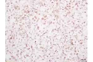 Formalin-fixed and paraffin embedded human breast carcinoma labeled with Rabbit Anti-YAP1 Polyclonal Antibody, Unconjugated 1:200 followed by conjugation to the secondary antibody and DAB staining (YAP1 抗体  (AA 131-330))