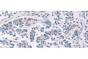 Immunohistochemistry of paraffin-embedded Human breast cancer tissue using LAMP3 Polyclonal Antibody at dilution of 1:30(x200) (LAMP3 抗体)