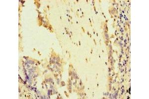 Immunohistochemistry of paraffin-embedded human lung cancer using ABIN7169011 at dilution of 1:100 (ATR 抗体  (AA 2405-2644))