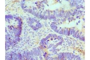 Immunohistochemistry of paraffin-embedded human ovarian cancer using ABIN7145049 at dilution of 1:100 (ATRIP 抗体  (AA 1-260))
