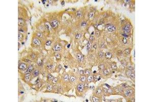 IHC analysis of FFPE human hepatocarcinoma tissue stained with IGFBP3 antibody (IGFBP3 抗体  (AA 163-193))