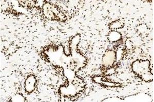 Immunohistochemical analysis of paraffin-embedded Human Prostate cancer section using Pink1 B. (CREB1 抗体  (AA 1-297))