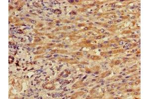 Immunohistochemistry of paraffin-embedded human liver cancer using ABIN7156490 at dilution of 1:100 (Integrin beta 5 抗体  (AA 431-637))