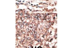 Formalin-fixed and paraffin-embedded human cancer tissue reacted with the primary antibody, which was peroxidase-conjugated to the secondary antibody, followed by AEC staining. (PDGFD 抗体  (AA 313-341))