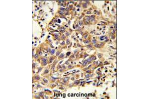 Formalin-fixed and paraffin-embedded human lung carcinoma reacted with CAT Antibody , which was peroxidase-conjugated to the secondary antibody, followed by DAB staining. (Catalase 抗体  (AA 152-180))