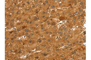 The image on the left is immunohistochemistry of paraffin-embedded Human liver cancer tissue using ABIN7192525(SLC7A9 Antibody) at dilution 1/35, on the right is treated with synthetic peptide.