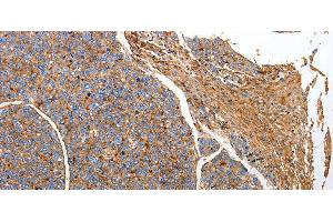 Immunohistochemistry of paraffin-embedded Human liver cancer tissue using CD151 Polyclonal Antibody at dilution 1:25 (CD151 抗体)