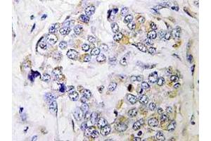 Immunohistochemistry (IHC) analyzes of PRIM1 antibody in paraffin-embedded human breast carcinoma tissue. (PRIM1 抗体)