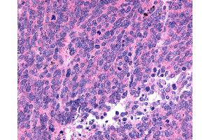 Anti-SSTR1 antibody IHC of human Lung, Small Cell Carcinoma. (SSTR1 抗体  (C-Term))