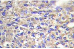 Immunohistochemistry (IHC) analyzes of Laminin beta-1 antibody in paraffin-embedded human liver carcinoma tissue. (Laminin beta 1 抗体)