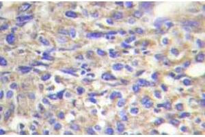 Immunohistochemistry (IHC) analyzes of Laminin beta-1 antibody in paraffin-embedded human liver carcinoma tissue. (Laminin beta 1 抗体)