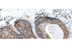 Immunohistochemistry of paraffin-embedded Human esophagus cancer tissue using AP1S3 Polyclonal Antibody at dilution of 1:70(x200) (AP1S3 抗体)