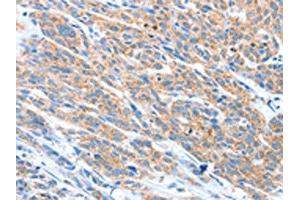 The image on the left is immunohistochemistry of paraffin-embedded Human esophagus cancer tissue using ABIN7128229(ADAM2 Antibody) at dilution 1/20, on the right is treated with fusion protein. (ADAM2 抗体)