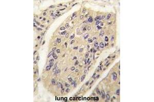 Formalin-fixed and paraffin-embedded human lung carcinoma tissue reacted with GHRH antibody (N-term) (ABIN392174 and ABIN2841887) , which was peroxidase-conjugated to the secondary antibody, followed by DAB staining. (GHRH 抗体  (N-Term))