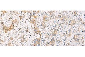 Immunohistochemistry of paraffin-embedded Human liver cancer tissue using FYCO1 Polyclonal Antibody at dilution of 1:110(x200) (FYCO1 抗体)