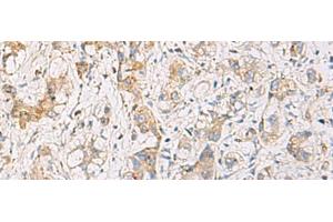 Immunohistochemistry of paraffin-embedded Human liver cancer tissue using FYCO1 Polyclonal Antibody at dilution of 1:110(x200)