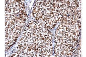 IHC-P Image FEN1 antibody detects FEN1 protein at nucleus on human breast carcinoma by immunohistochemical analysis. (FEN1 抗体)