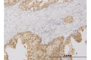 Immunoperoxidase of monoclonal antibody to RIPK2 on formalin-fixed paraffin-embedded human prostate. (RIPK2 抗体  (AA 431-540))