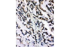 Anti-SNRPN antibody, IHC(P) IHC(P): Human Intestinal Cancer Tissue (SNRPN 抗体  (N-Term))