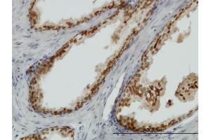 Immunoperoxidase of monoclonal antibody to FOXA1 on formalin-fixed paraffin-embedded human prostate.