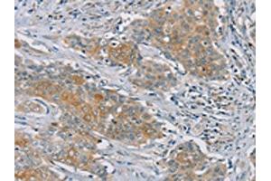 The image on the left is immunohistochemistry of paraffin-embedded Human ovarian cancer tissue using ABIN7192147(RASA2 Antibody) at dilution 1/45, on the right is treated with synthetic peptide. (RASA2 抗体)