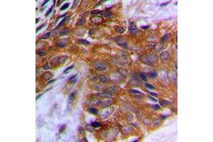 Immunohistochemical analysis of PAK1 (pT212) staining in human prostate cancer formalin fixed paraffin embedded tissue section. (PAK1 抗体  (pSer212))