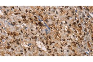 Immunohistochemistry of paraffin-embedded Human liver cancer tissue using TSPEAR Polyclonal Antibody at dilution 1:50 (TSPEAR 抗体)