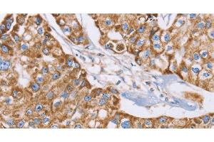 Immunohistochemistry of paraffin-embedded Human breast cancer tissue using GUCY1A3 Polyclonal Antibody at dilution 1:40 (GUCY1A1 抗体)