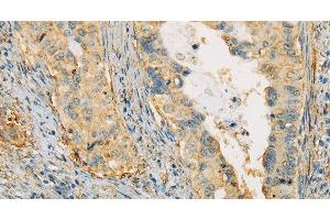 Immunohistochemistry of paraffin-embedded Human cervical cancer tissue using APOA4 Polyclonal Antibody at dilution 1:30