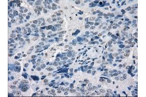 Immunohistochemical staining of paraffin-embedded Adenocarcinoma of breast tissue using anti-POR mouse monoclonal antibody. (POR 抗体)