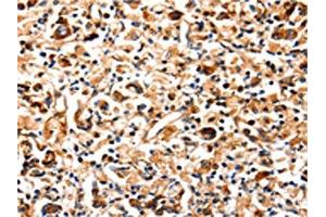 The image on the left is immunohistochemistry of paraffin-embedded Human gastric cancer tissue using ABIN7129022(COX8A Antibody) at dilution 1/12, on the right is treated with fusion protein. (COX8A 抗体)