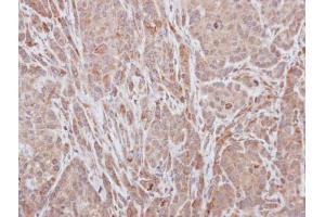 IHC-P Image Immunohistochemical analysis of paraffin-embedded A549 xenograft, using ADAMTS5, antibody at 1:100 dilution. (ADAMTS5 抗体  (C-Term))