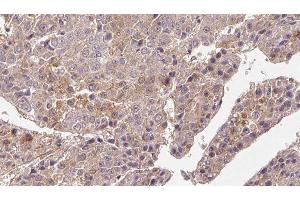 ABIN6276687 at 1/100 staining Human liver cancer tissue by IHC-P. (FSHR 抗体  (Internal Region))
